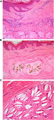 Gout With Associated Cutaneous AA Amyloidosis: A Case Report and Review of the Literature